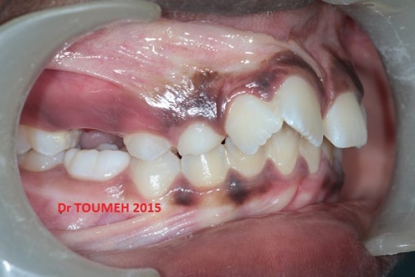 Canines incluses , traitement orthodontique 731