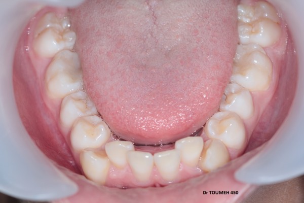 DDM importante, traitement orthodontique sans extraction