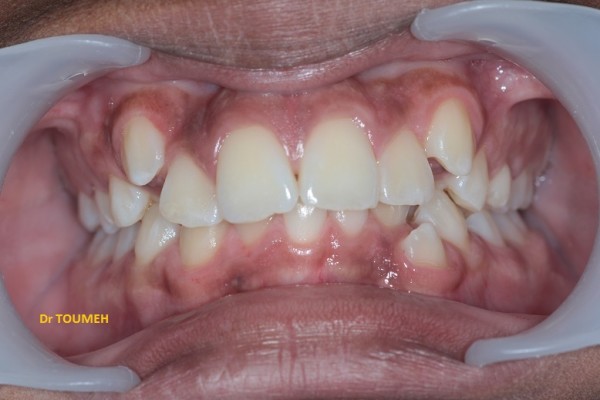Traitement orthodontique de la DDM sans extraction