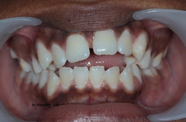 Succion de pouce, traitement par orthodontie