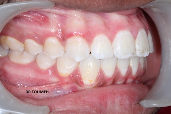 Orthodontie précoce, traitement DDM, alignement, Orthodontiste