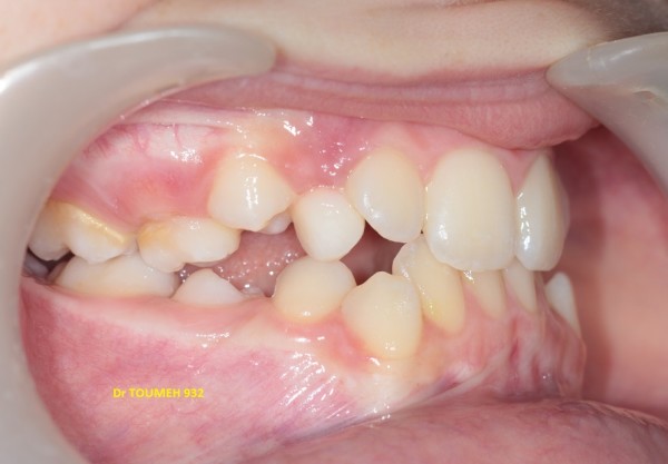 Orthodontie, traitement orthodontique de la DDM sans extraction, amélioration du sourire